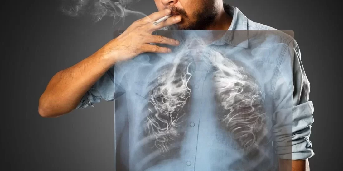 dampak buruk rokok bagi paru-paru